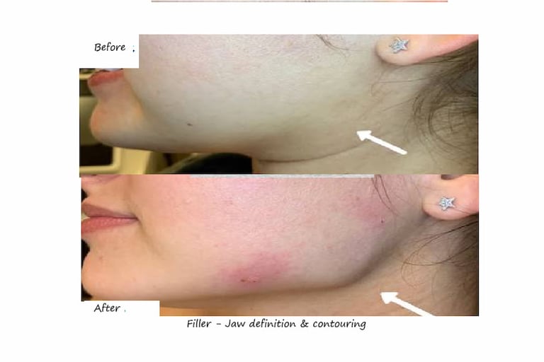 Före- & efterbild filler käklinje – tydligare ansiktskontur, smalare profil och väl markerad käke.