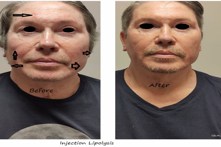 Fat reduction Delhi before and after photo – injection lipolysis face for fat nodules.