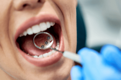 Lingual Braces Sydney
