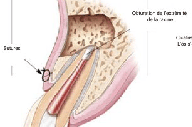 Chirurgie endodontique