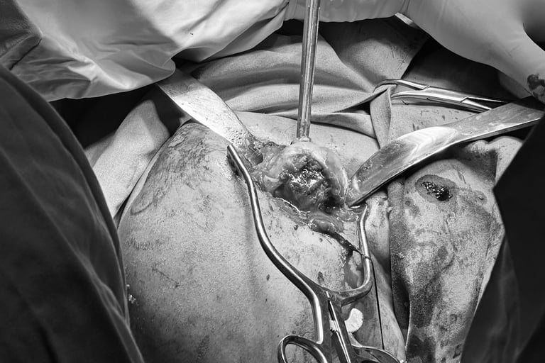 Preparación del húmero en prótesis reversa de hombro