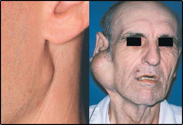adenoma pleomórfico patologias de glândulas salivares resumo patologia bucal