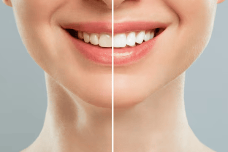 Best Teeth Whitening Treatment Clinic in Vashi, Navi Mumbai | Ekdantam dental clinic