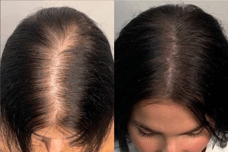 Best Scalp Micropigmentation Toronto_ATRUBARBER