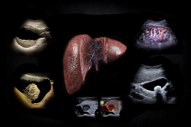 Image of the liver showing internal vessels with abdominal ultrasound images placed around it.