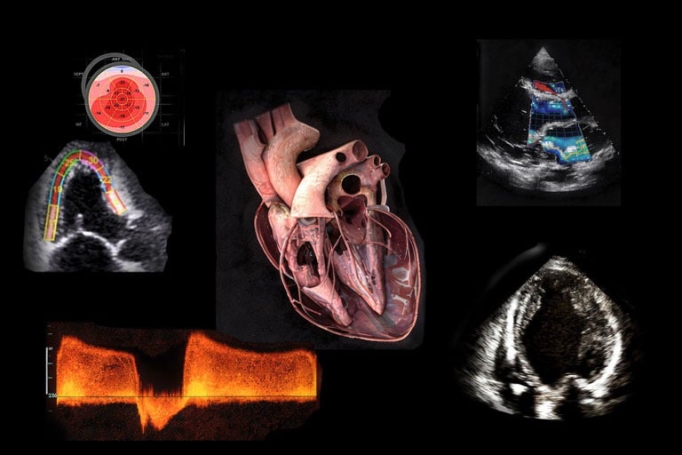 Echocardiogram diagnostic images displaying cardiac ultrasound, Doppler flow, and 3D heart anatomy.