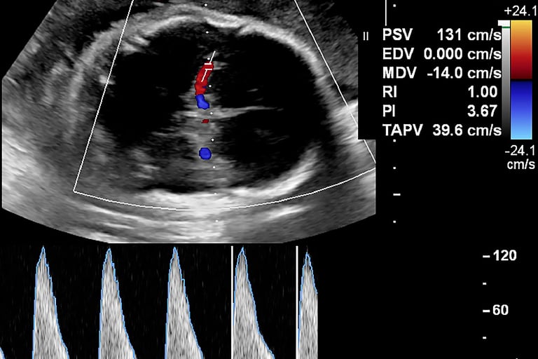Fetal ultrasound image showing color and spectral Doppler in the brain.