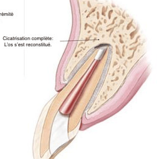 Chirurgie endodontique