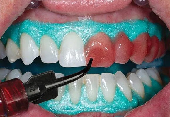 a image showing teeth whitening gel being applied on teeth 