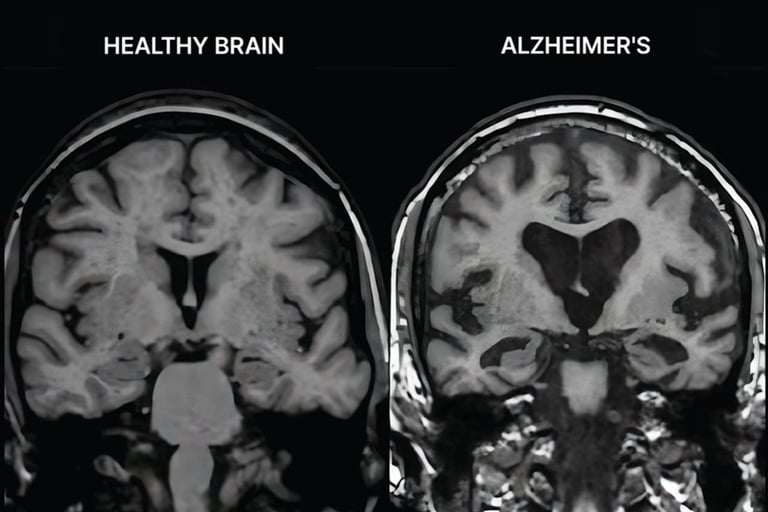 image montant un cerveau sain et un atteint par Alzheimer
