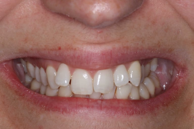 a close up of a person's mouth with mis aligned teeth