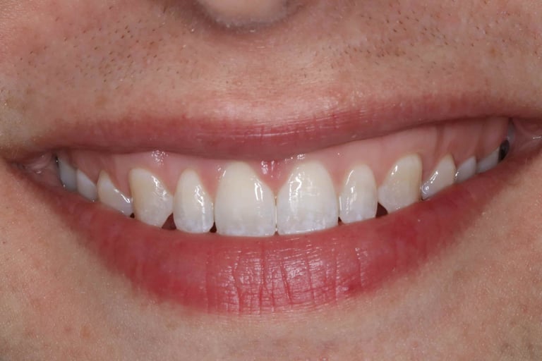 a close up of a person's teeth after invisalign aligner treatment