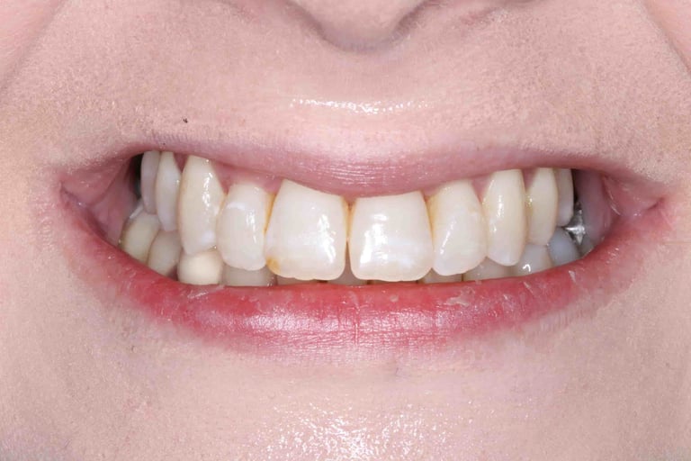a close up of a person's teeth after invisalign aligner treatment