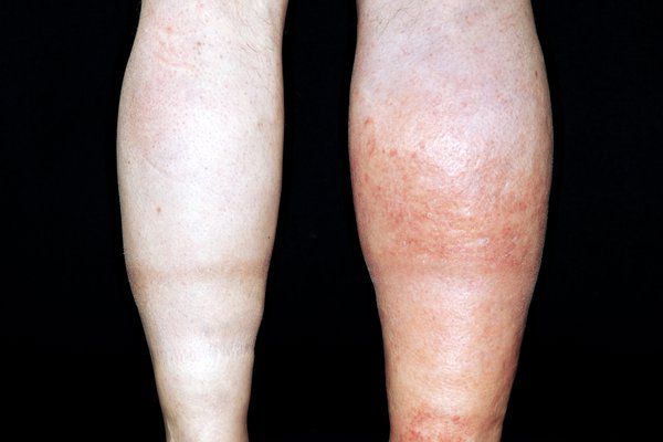 vascular ultrasound blood clot deep vein thrombosis leg swelling thinner anticoagulant embolism pain doppler factor v leiden