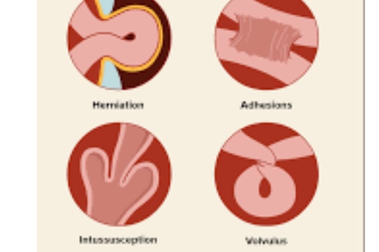 Emesis and Upper Digestive Tract Blockages