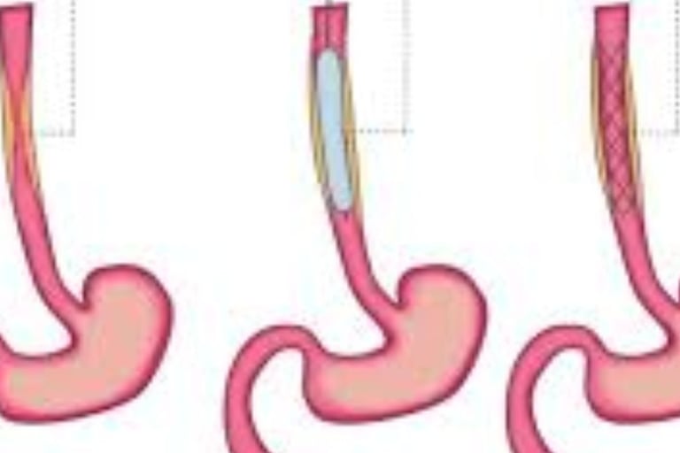 Emesis and Upper Digestive Tract Blockages