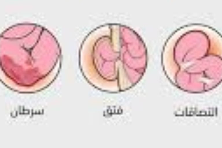 القيء من انسدادات الجهاز الهضمي العلوي