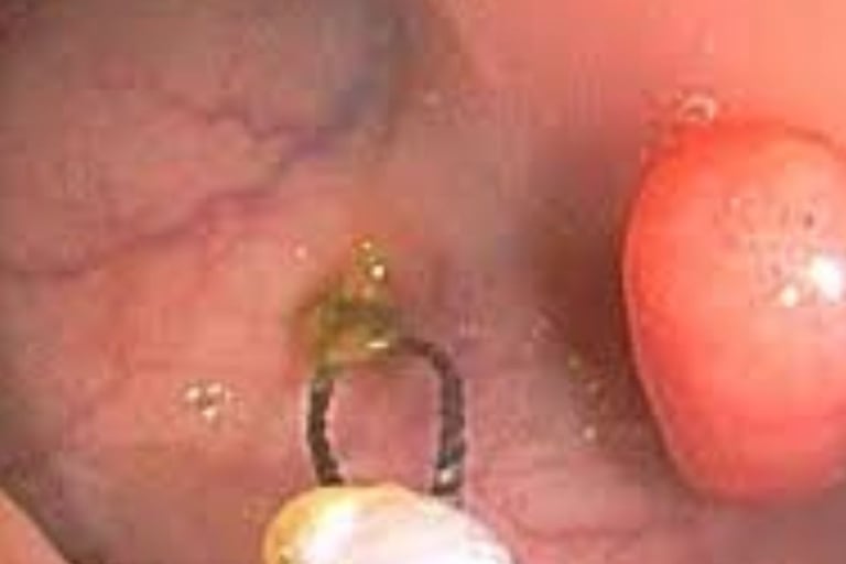 Emesis and Upper Digestive Tract Blockages