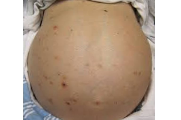 Abdominal Distension