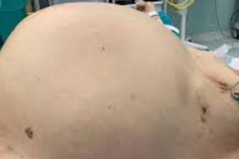 Abdominal Distension