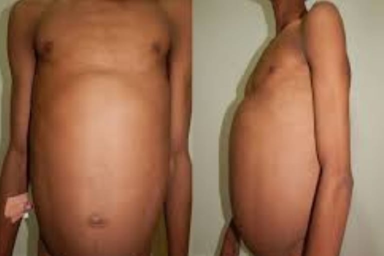 Abdominal Distension
