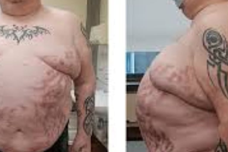 Ascites