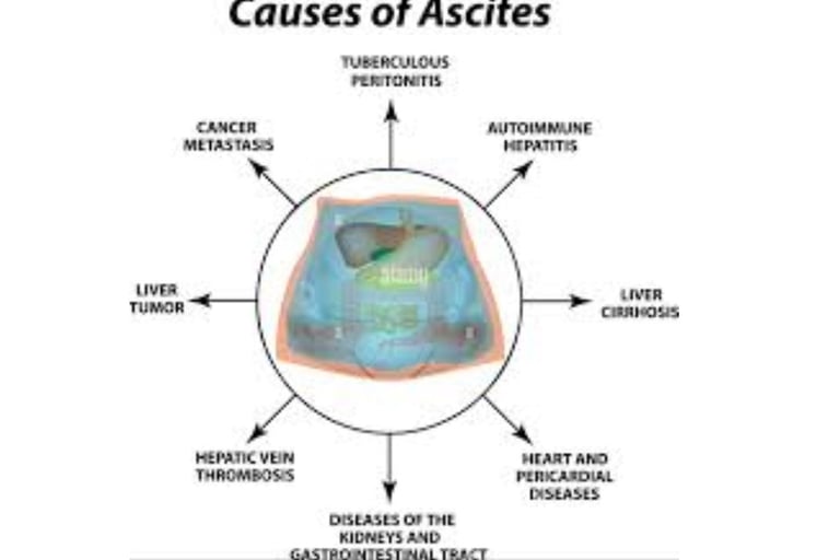 Abdominal Paracentesis causes