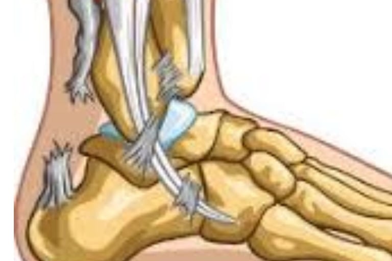 Achilles Tendon Injury