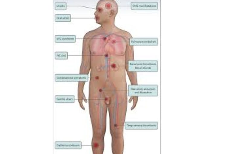 behçet's disease diagnostic criteria