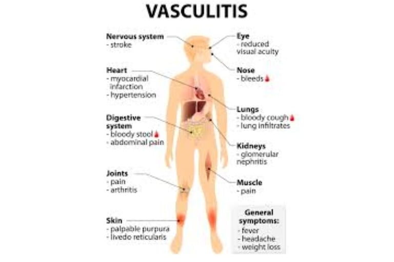 vasculitis