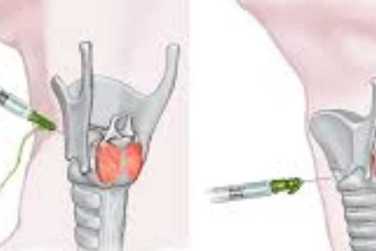 injection for laryngeal spasm