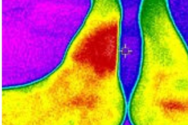 temperature increase (saturated red zone) caused by a bee sting after about 28 hours
