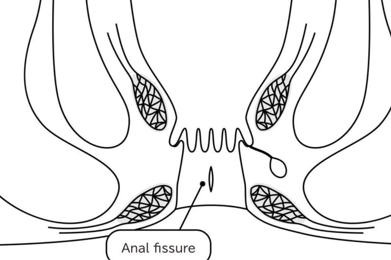 🍯Anal Fissures and Fistulas try honey first