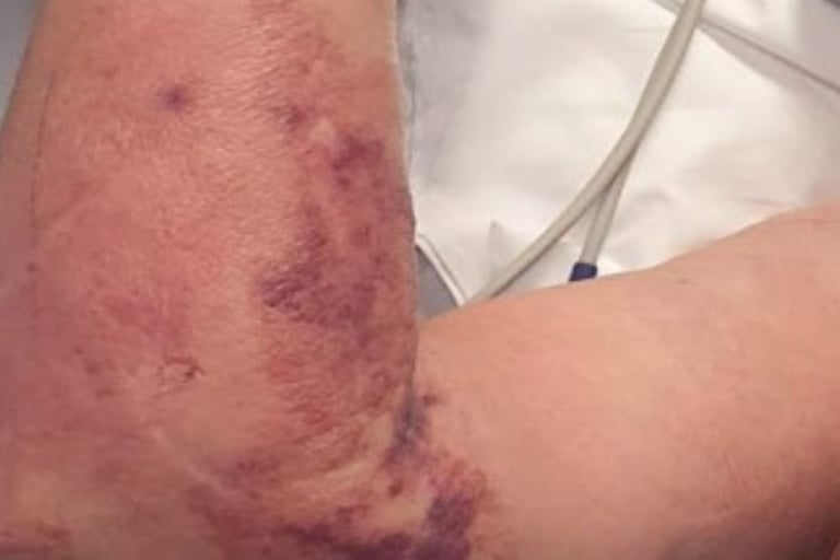 🦠 Flesh-Eating Disease (Necrotizing Fasciitis)