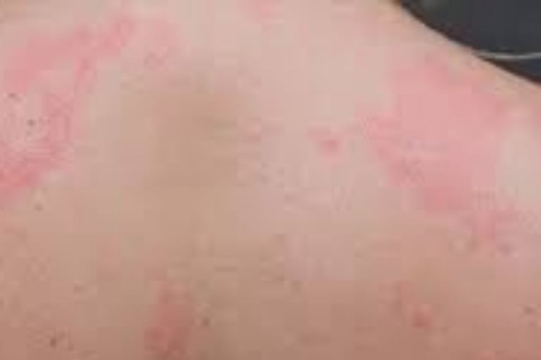 🧬 How Fasting Calms the Immune System in Psoriasis and Eczema