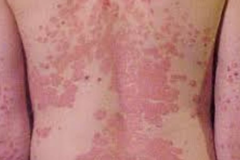 🧬 How Fasting Calms the Immune System in Psoriasis and Eczema