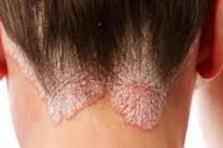 🧬 How Fasting Calms the Immune System in Psoriasis and Eczema