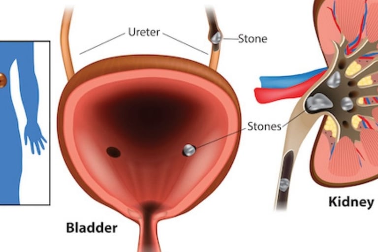 💧🧊🌙Fasting and Kidney Stones : What You Need to Know