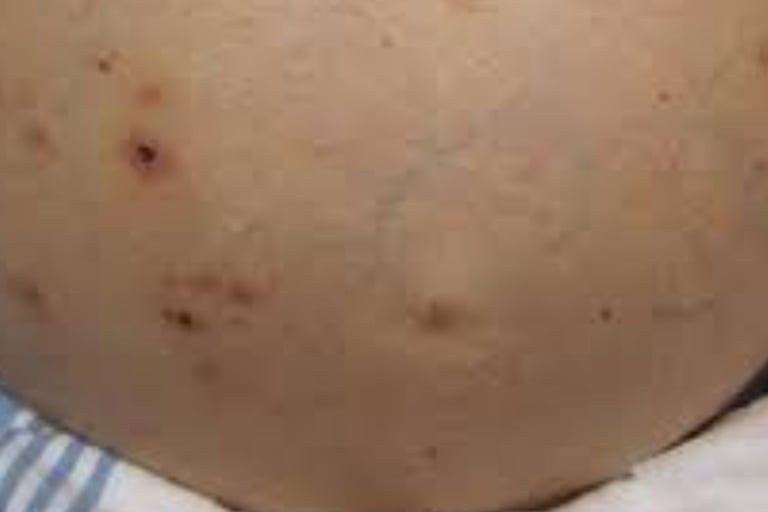 Fasting for Skin Allergies, Itching, and Pruritus