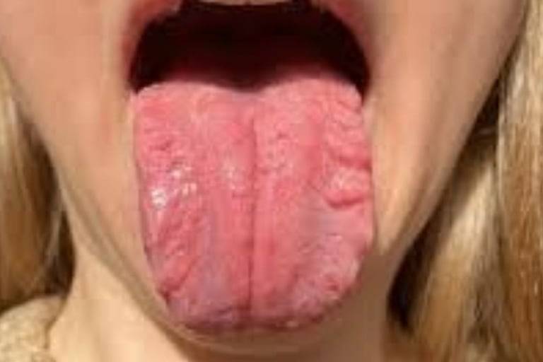 FISSURED TONGUE