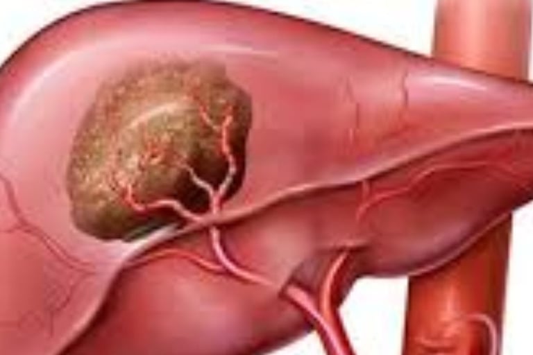 استخدام الصيام والعسل في علاج الخراجات المتعددة