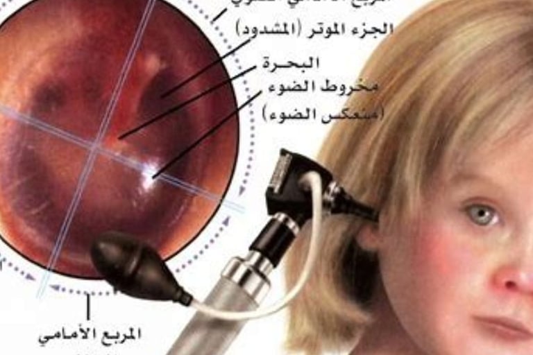 لعلاج تسوس الأذن والوقاية بنقط العسل mastoiditis 