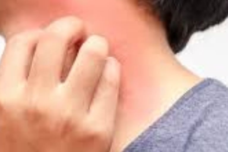 الصيام لعلاج حساسية الجلد الحكة والهرش