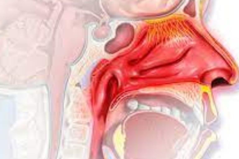 Honey The only Remedies for Posterior Nasal Bleeding