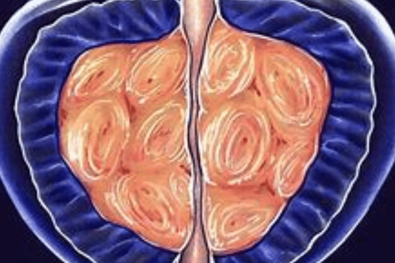 Shrinking Enlarged Prostate - BPH and Cancer Treatment