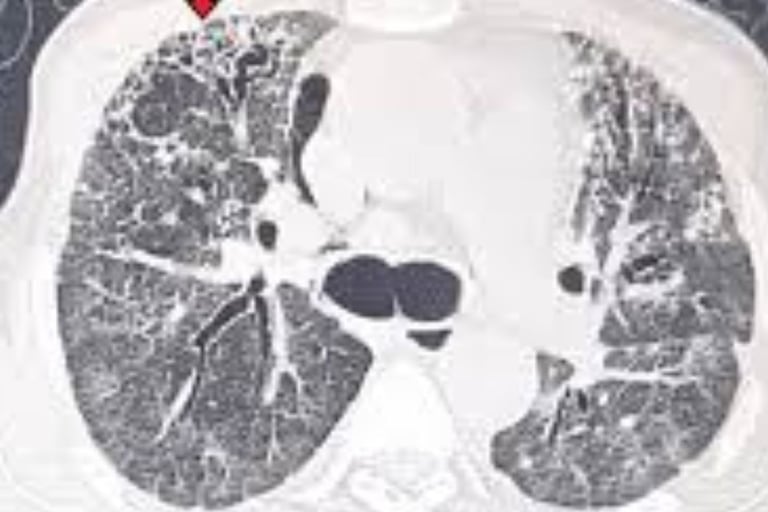 rheumatoid arthritis extra-articular manifestations