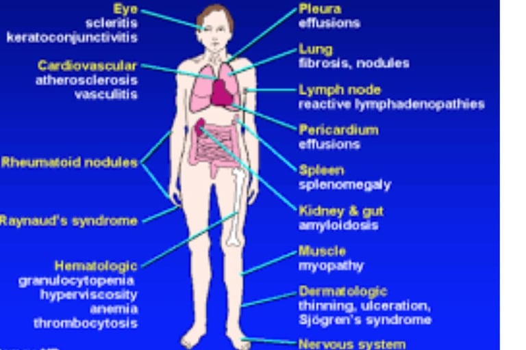 rheumatoid arthritis extra-articular manifestations