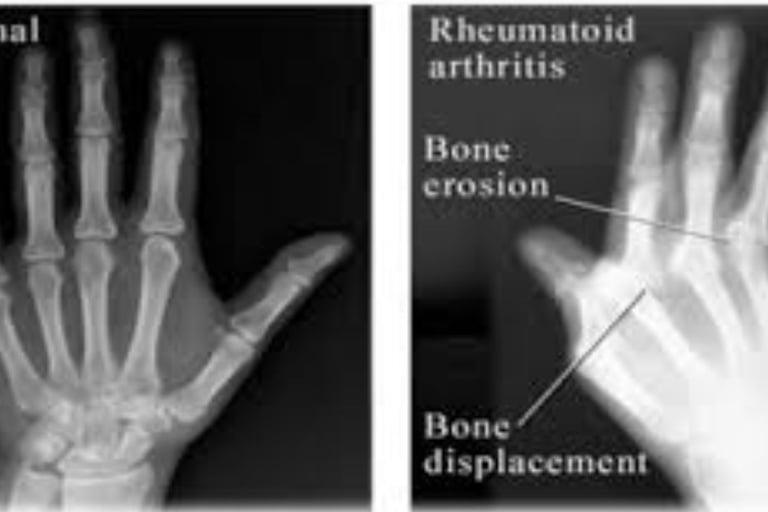 Rheumatoid Arthritis
