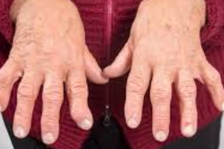 Rheumatoid Arthritis RA : A Multidisciplinary Approach to Management