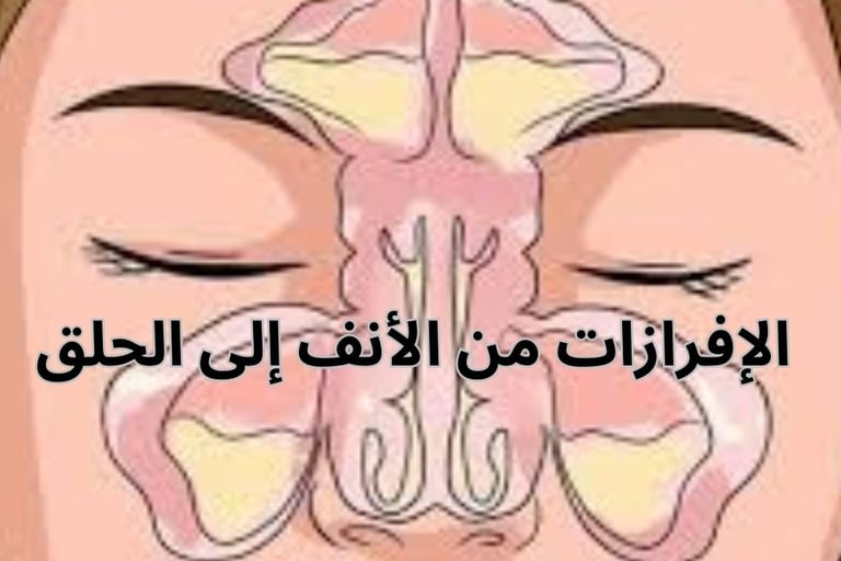 علاج إفرازات الأنف الخلفية الناجمة عن التهابات الجيوب
